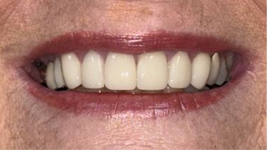 Close up of a smile with whiter teeth