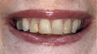 Close up of a smile with yellowed teeth