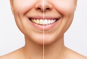 Closeup of patient's smile before and after teeth whitening